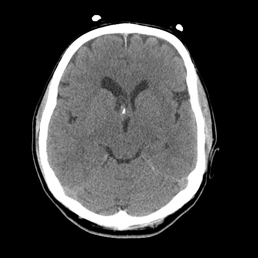 Central neurocytoma (Radiopaedia 68725-78432 Axial non-contrast 21).jpg