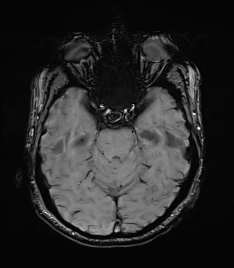 Central neurocytoma (Radiopaedia 71068-81303 Axial SWI 18).jpg