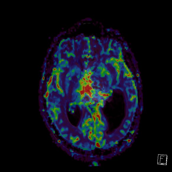 Central neurocytoma (Radiopaedia 84497-99872 Axial Perfusion 167).jpg