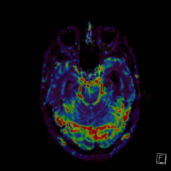 Central neurocytoma (Radiopaedia 84497-99872 Axial Perfusion 221).jpg