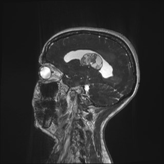 Central neurocytoma (Radiopaedia 84497-99872 Sagittal CISS 17).jpg