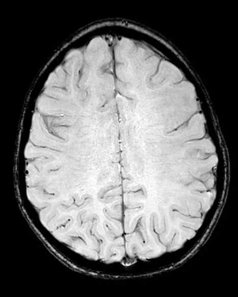 Cerebellar abscess (Radiopaedia 73727-84563 Axial SWI 51).jpg