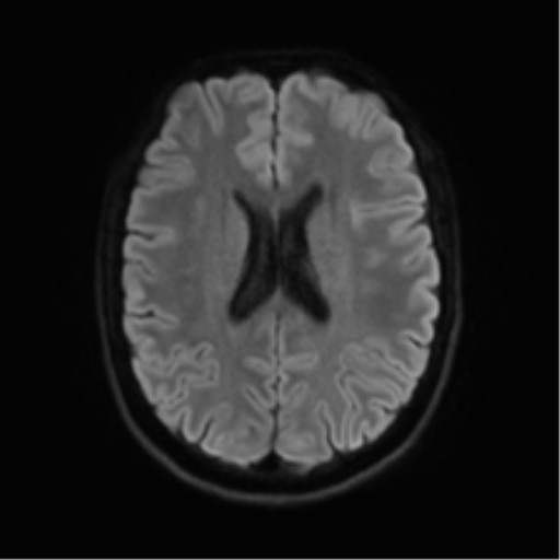 Cerebellar agenesis with hypoplastic pons (pontocerebellar hypoplasia) (Radiopaedia 57224-64138 Axial DWI 60).png