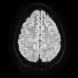 Cerebellar hemangioblastoma (Radiopaedia 29570-30077 Axial DWI 20).jpg