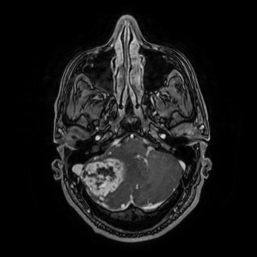 File:Cerebellar hemangioblastoma (Radiopaedia 88055-104622 Axial T1 C+ 50).jpg