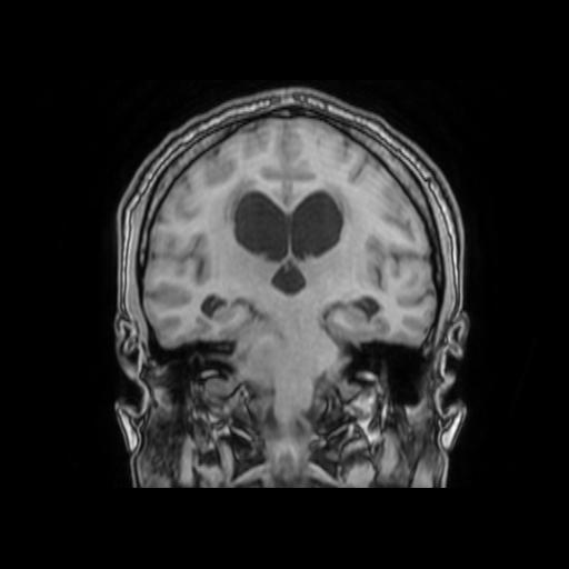 File:Cerebellar hemangioblastoma (Radiopaedia 88055-104622 Coronal T1 21).jpg