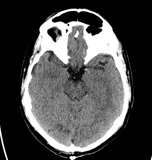 File:Cerebellar infarct due to vertebral artery dissection with posterior fossa decompression (Radiopaedia 82779-97031 Axial non-contrast 12).png
