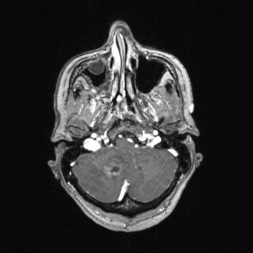 Cerebellar metastases (Radiopaedia 24038-24249 Axial T1 C+ 47).jpg
