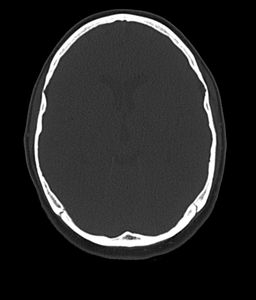 Cerebellar metastases - colorectal adenocarcinoma (Radiopaedia 40947-43652 AX Bone C- 2.0 MPR 29).png