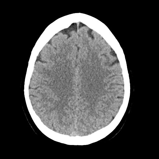 File:Cerebellar metastasis (Radiopaedia 54578-60812 Axial non-contrast 35).png