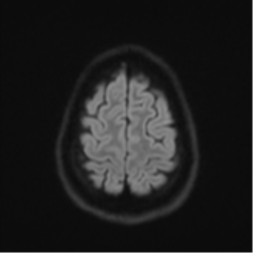 Cerebellar metastasis - adenocarcinoma lung (Radiopaedia 63184-71715 Axial DWI 54).png