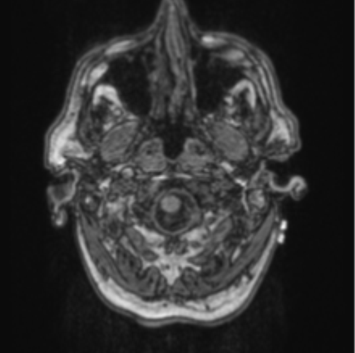 Cerebellar metastasis from lung adenocarcinoma (Radiopaedia 86690-102829 Axial T1 10).png