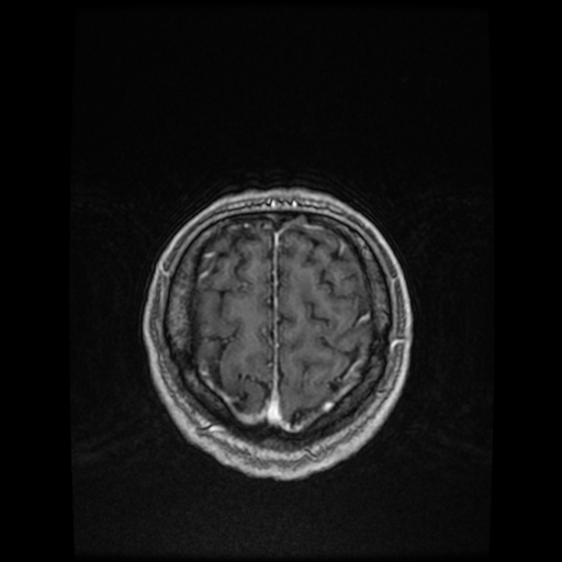 Cerebellar metastasis of pulmonary adenocarcinoma, cavernous venous malformation, and developmental venous anomaly (Radiopaedia 85827-101661 Axial T1 C+ 80).jpg