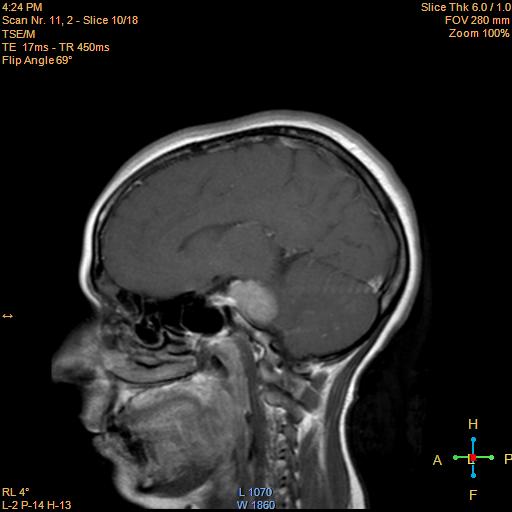 File:Cerebellopontine angle meningioma (Radiopaedia 22488-22525 Sagittal T1 C+ 10).jpg
