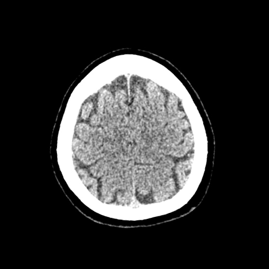 Cerebellopontine angle meningioma (Radiopaedia 53561-59592 Axial non-contrast 57).jpg