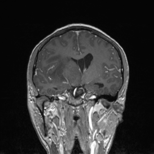 Cerebral abscess (Radiopaedia 24212-24478 Coronal T1 C+ 106).jpg