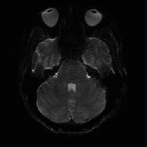 Cerebral abscess (Radiopaedia 57774-64740 Axial DWI 36).png
