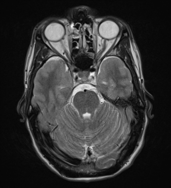 File:Cerebral abscess (Radiopaedia 60342-68009 Axial T2 10).png