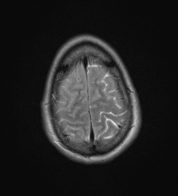 File:Cerebral abscess (Radiopaedia 60342-68009 Axial T2 32).png