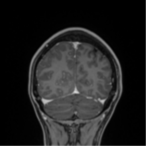 File:Cerebral abscess (Radiopaedia 60342-68009 H 6).png