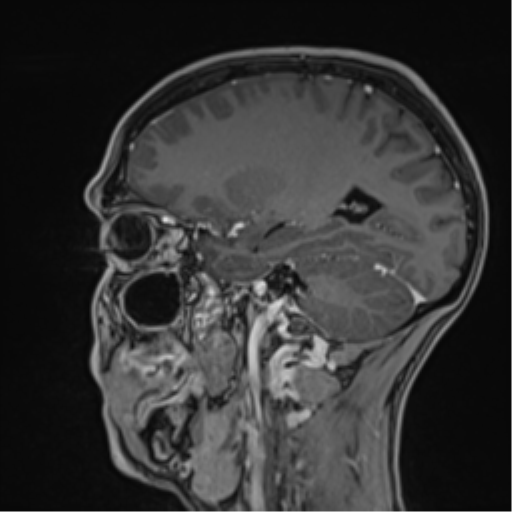 Cerebral abscess (Radiopaedia 60342-68009 J 21).png