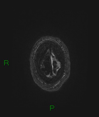 Cerebral abscess and subdural empyema (Radiopaedia 84436-99779 Axial FLAIR 10).jpg