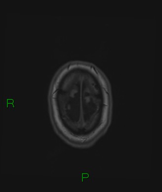 Cerebral abscess and subdural empyema (Radiopaedia 84436-99779 Axial T1 11).jpg