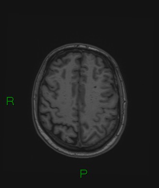 Cerebral abscess and subdural empyema (Radiopaedia 84436-99779 Axial T1 26).jpg