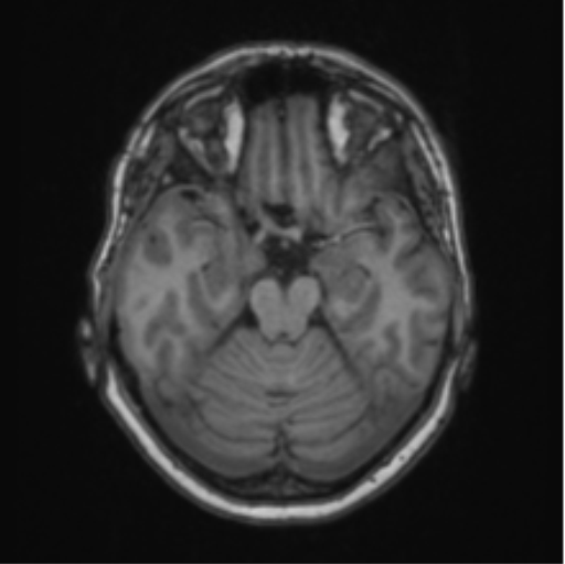 Cerebral abscess from pulmonary arteriovenous malformation (Radiopaedia 86275-102291 Axial T1 29).png