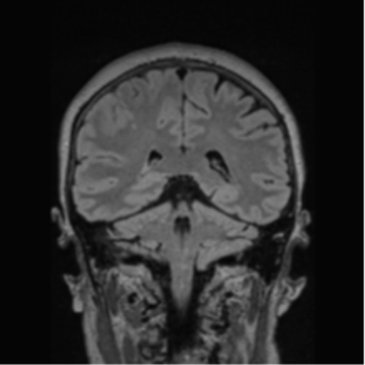 Cerebral abscess from pulmonary arteriovenous malformation (Radiopaedia 86275-102291 Coronal FLAIR 35).png