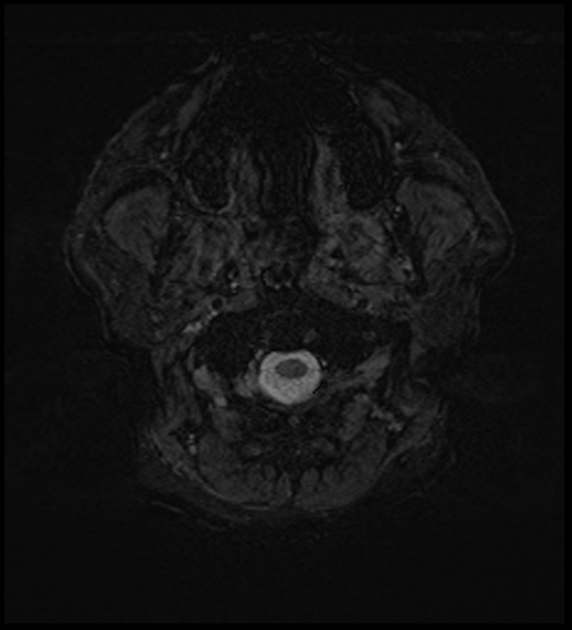 Cerebral abscess with ventriculitis (Radiopaedia 78965-91878 Axial SWI 1).jpg