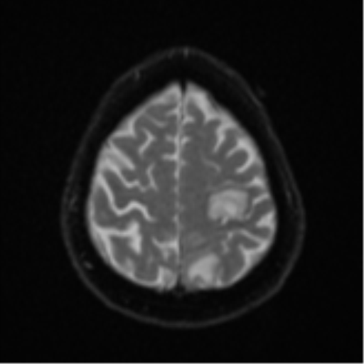 Cerebral abscesses- medically managed (Radiopaedia 45183-49179 Axial DWI 23).png