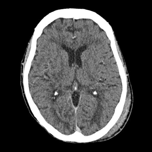 Cerebral amyloid angiopathy-related inflammation (Radiopaedia 74836-85848 Axial non-contrast 34).jpg