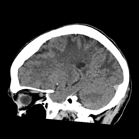 Cerebral amyloid angiopathy-related inflammation (Radiopaedia 74836-85848 C 39).jpg