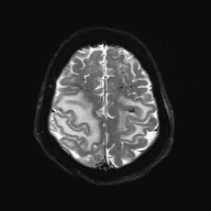 Cerebral amyloid angiopathy-related inflammation (Radiopaedia 74836-85849 Axial DWI 23).jpg