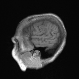 File:Cerebral amyloid angiopathy-related inflammation (Radiopaedia 74836-85849 Sagittal T1 7).jpg