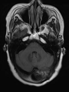 File:Cerebral amyloid angiopathy (Radiopaedia 29129-29518 Axial FLAIR 5).jpg