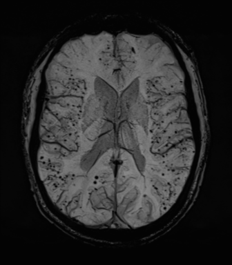 Cerebral amyloid angiopathy (Radiopaedia 46082-50433 Axial SWI MIP 44).png