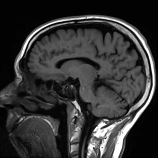 File:Cerebral amyloid angiopathy (Radiopaedia 46082-50433 Sagittal T1 16).png