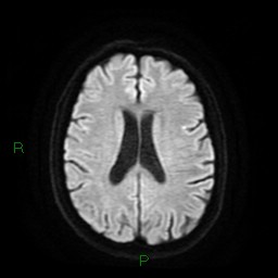 Cerebral amyloid angiopathy (Radiopaedia 77506-89664 Axial DWI 18).jpg