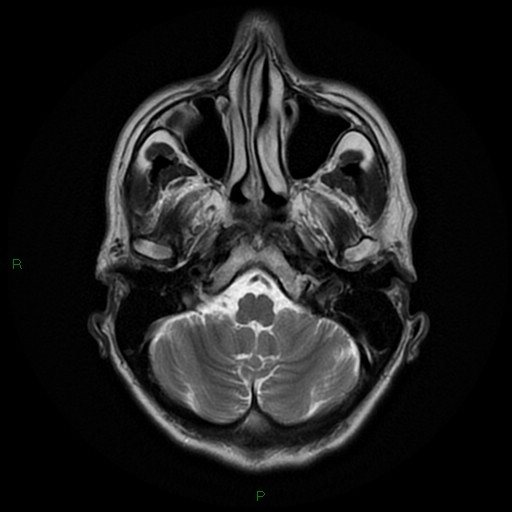 File:Cerebral amyloid angiopathy (Radiopaedia 77506-89664 Axial T2 6).jpg