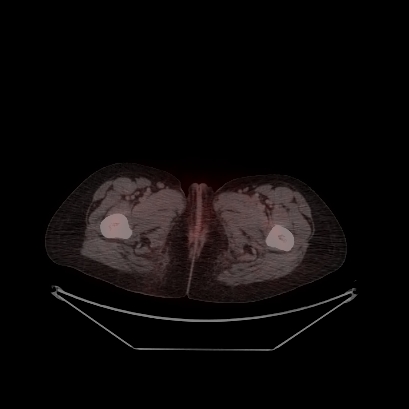 Cerebral and abdominal tuberculosis (Radiopaedia 90499-107853 C 252).jpg