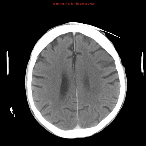 File:Cerebral and orbital tuberculomas (Radiopaedia 13308-13310 B 20).jpg