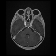 Cerebral and spinal tuberculosis (Radiopaedia 90489-107837 Axial T1 C+ 65).jpg