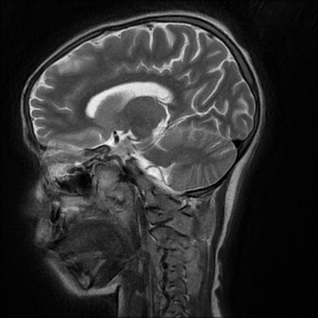 File:Cerebral and spinal tuberculosis (Radiopaedia 90489-107837 Sagittal T2 13).jpg