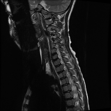 File:Cerebral and spinal tuberculosis (Radiopaedia 90489-107838 Sagittal 3).jpg