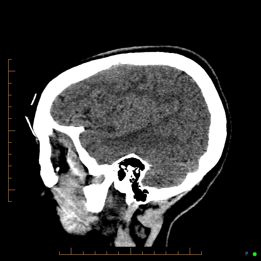 File:Cerebral arteriovenous malformation (AVM) (Radiopaedia 78162-90706 A 17).jpg