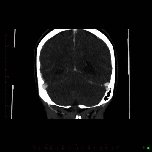 Cerebral arteriovenous malformation (AVM) (Radiopaedia 78162-90706 Coronal CTA 31).jpg