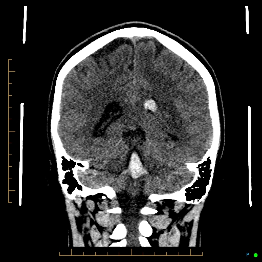 Cerebral arteriovenous malformation (AVM) (Radiopaedia 78162-90706 Coronal non-contrast 65).jpg