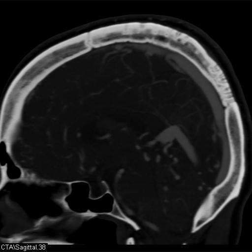 Cerebral arteriovenous malformation (Radiopaedia 28518-28759 D 35).jpg